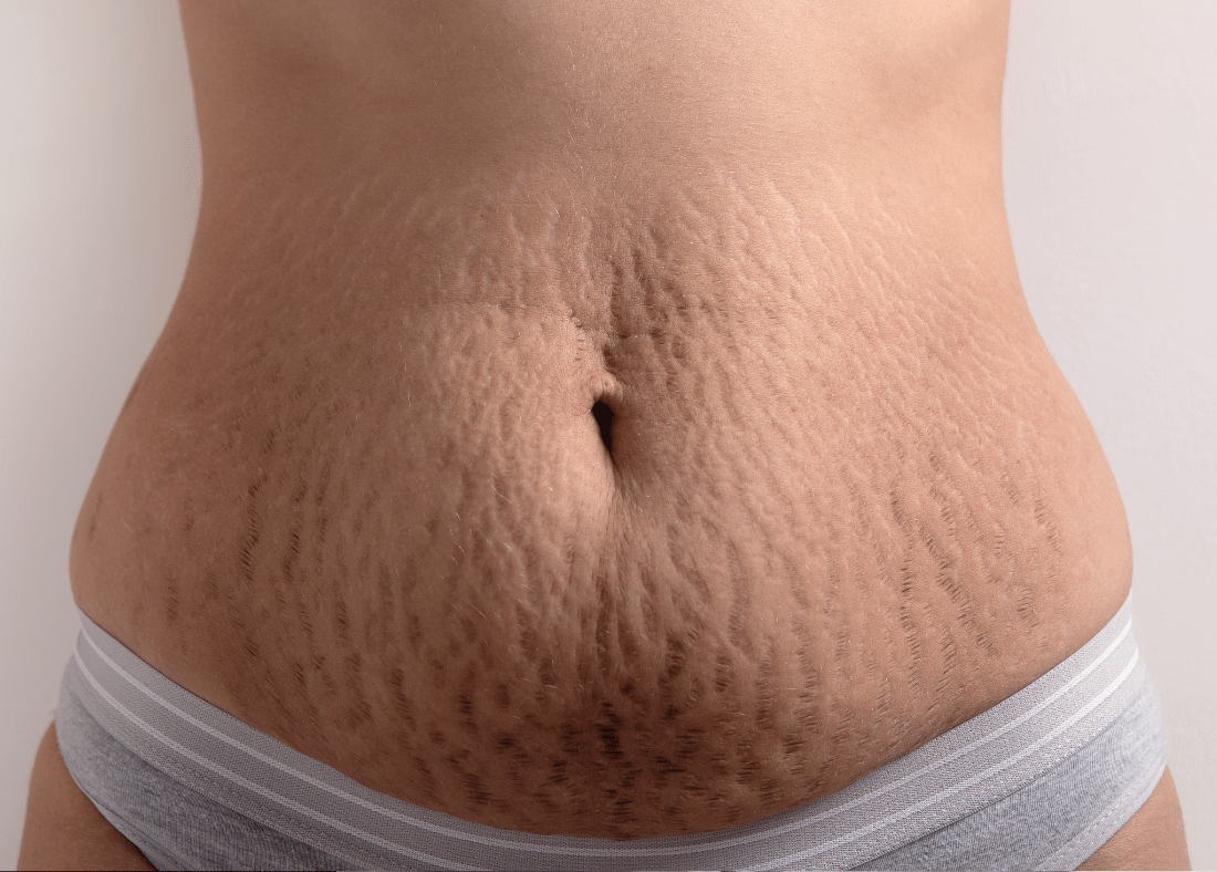 stretch marks